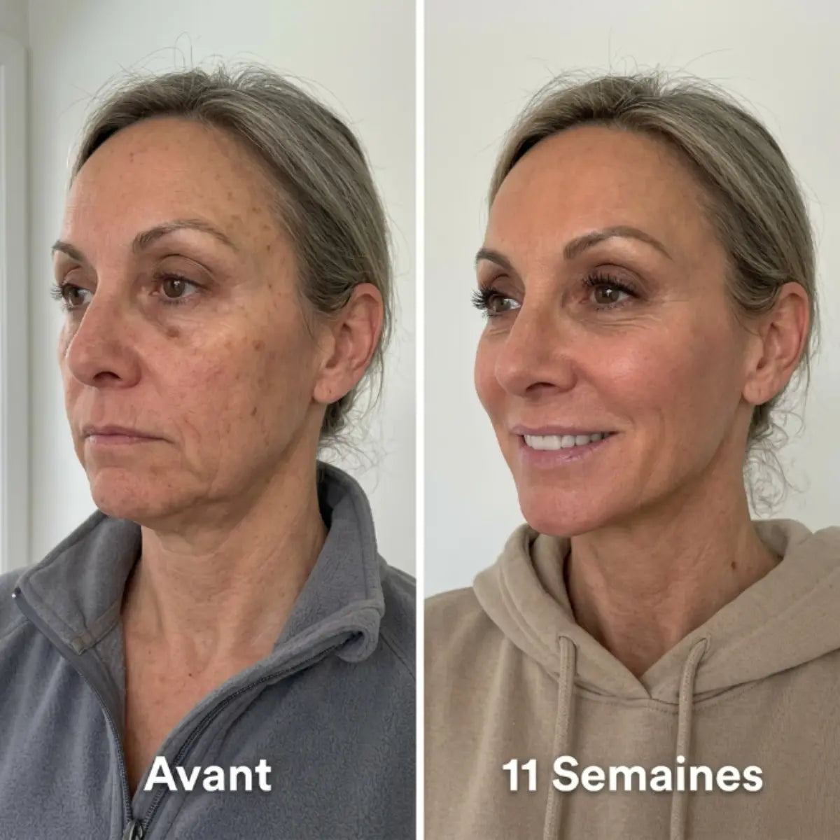 Le masque qui sculpte le visage et la mâchoire.